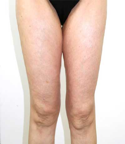 Dopo il trattamento per ritenzione idrica e cellulite