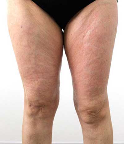 Prima del trattamento per ritenzione idrica e cellulite